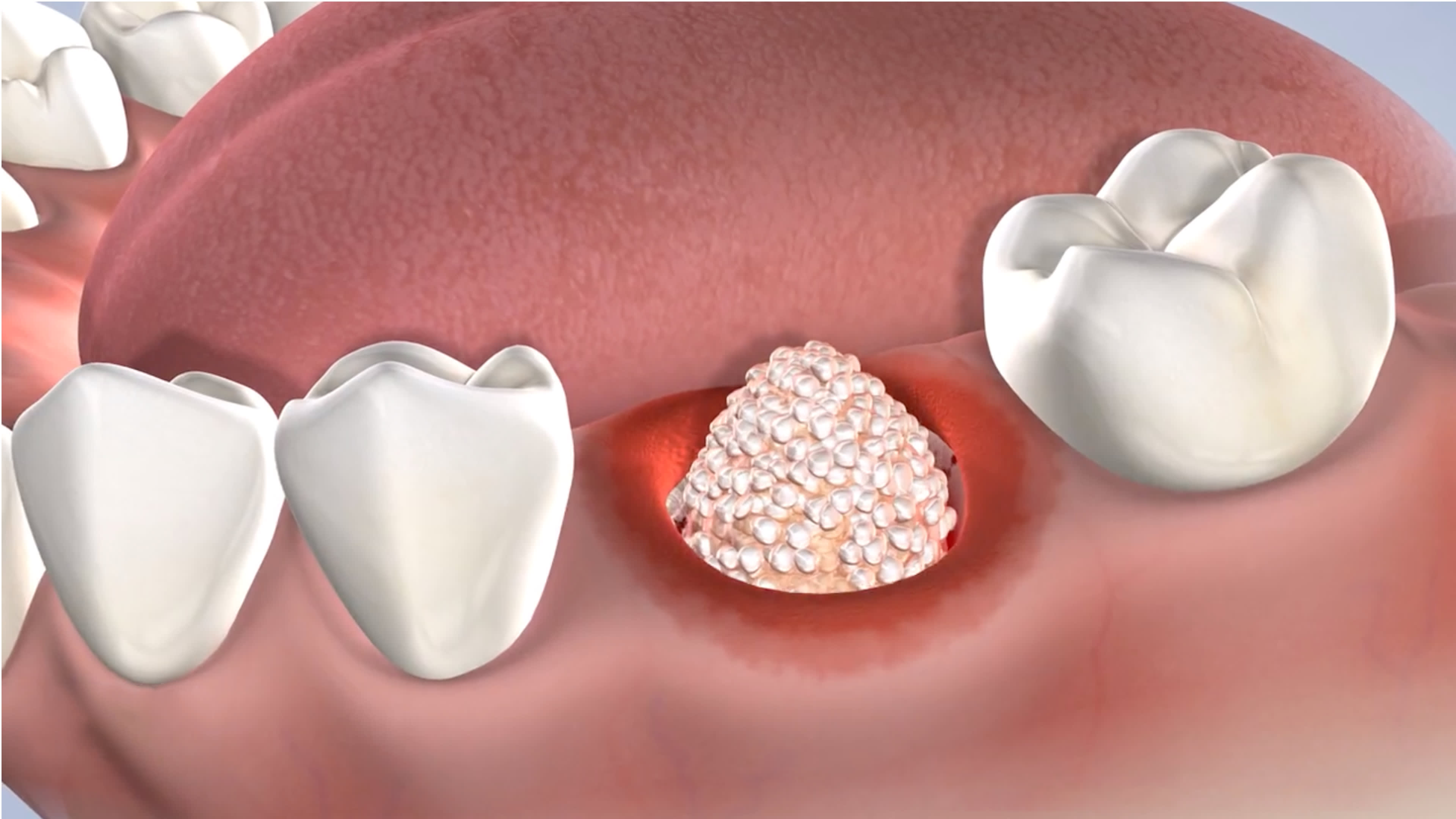 Instruction post operation bone grafting