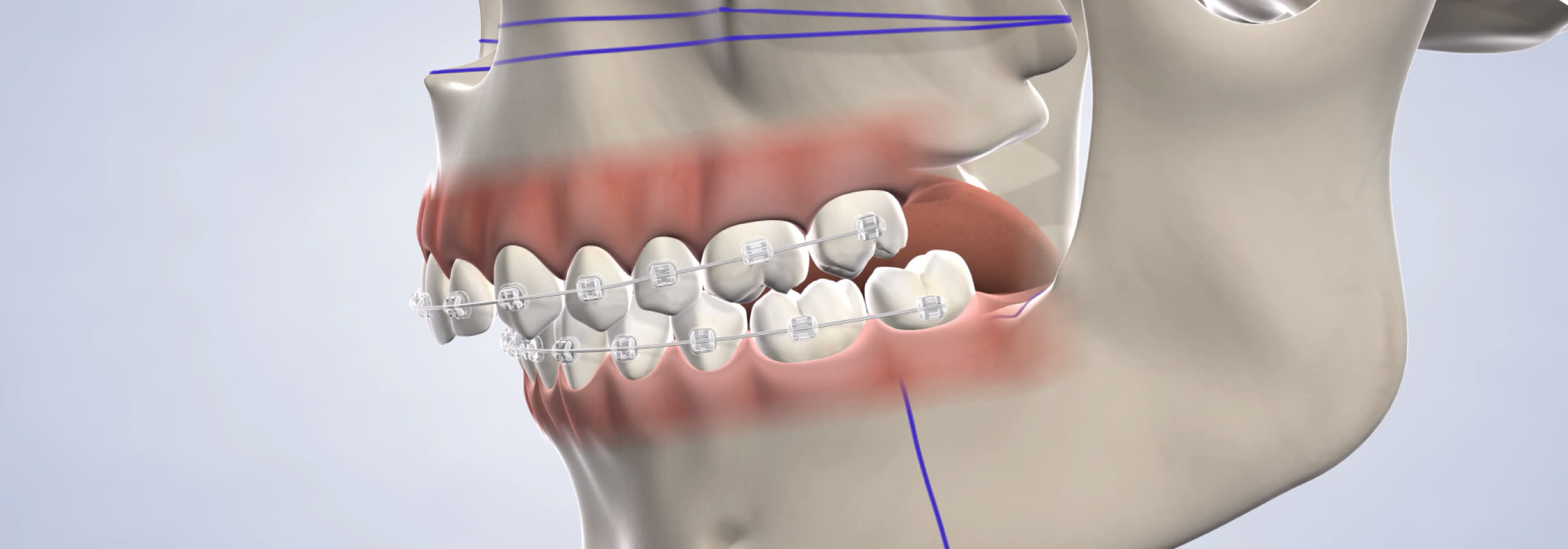 Jaw surgery procedure desktop