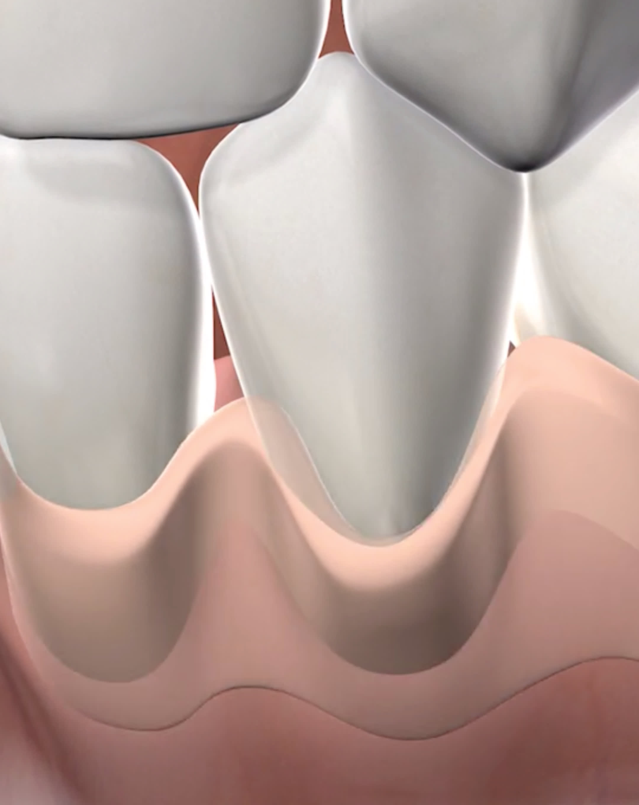 Procedure soft tissue grafting mobile